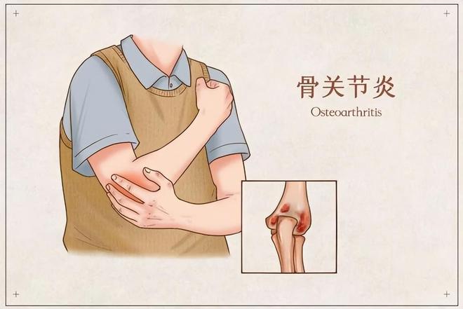 长期出现这些症状可能是关节炎在作怪！千亿球友会平台且行且珍“膝”!老年人(图2)